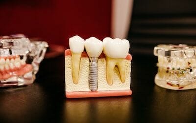 What You Should Know Before Getting Dental Implants