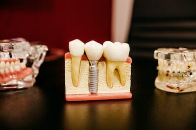 What You Should Know Before Getting Dental Implants