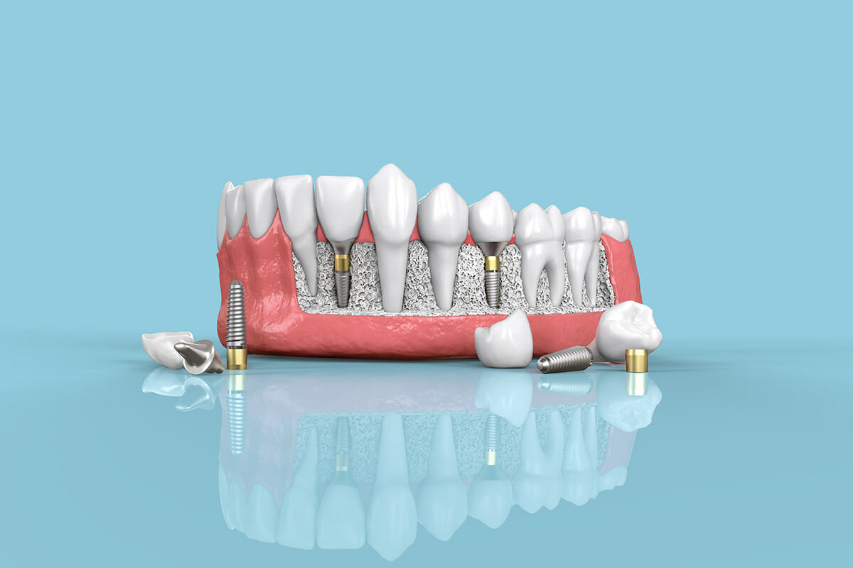 Dental Implants (Full Procedure)