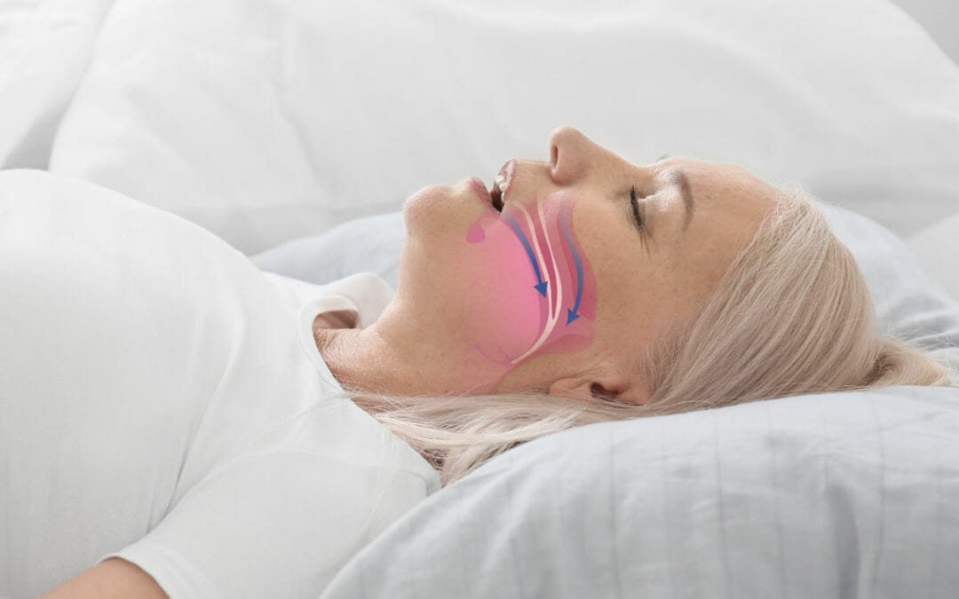 Women struggling with sleep apnea.