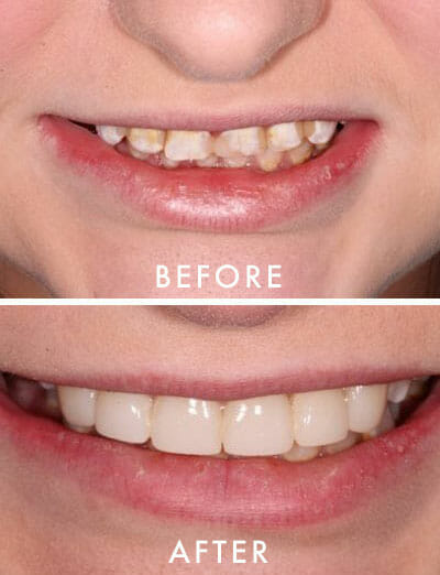 teeth before and after