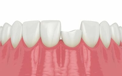 Chipped or Broken Tooth Treatment & Repair