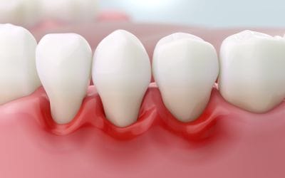 How Perio Protect Prescription Trays Help Fight Gum Disease at Home