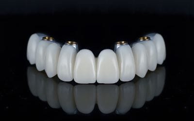 All-on-4 vs. Bridges: Which Is the Best Solution for Missing Teeth?